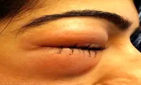 کور شدن یک زن بخاطر فین کردن شدید +عکس