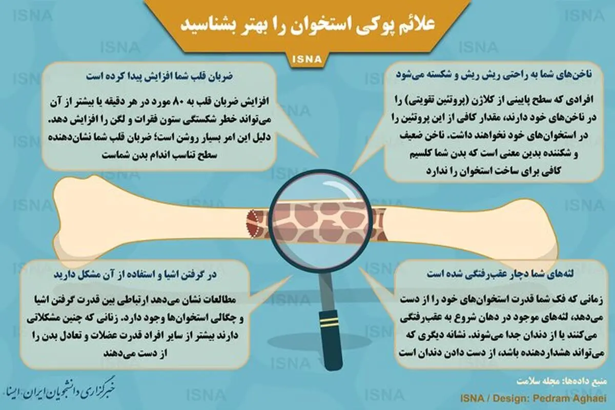 علائم پوکی استخوان را بهتر بشناسید + اینفوگرافیک
