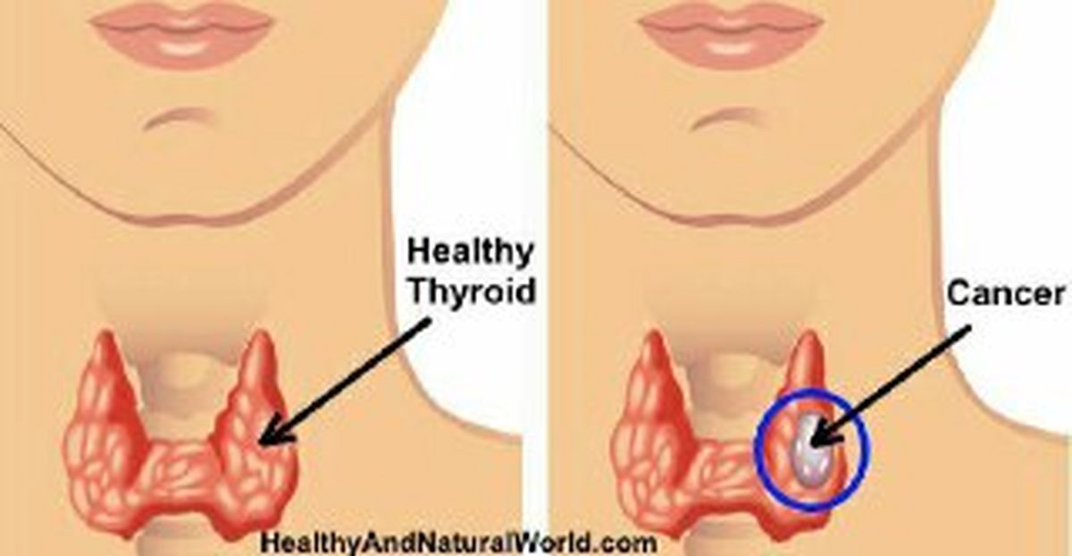 علائم سرطان تیروئید