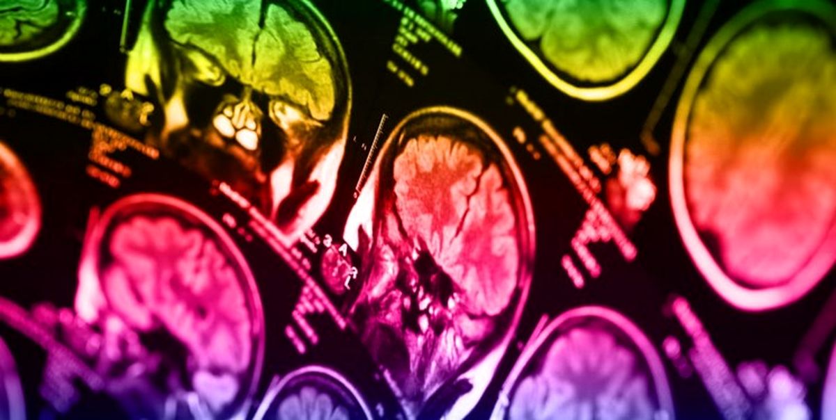 پی بردن به میزان احتمال خودکشی با اسکن مغز انسان