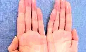 درمان قارچ پوستی