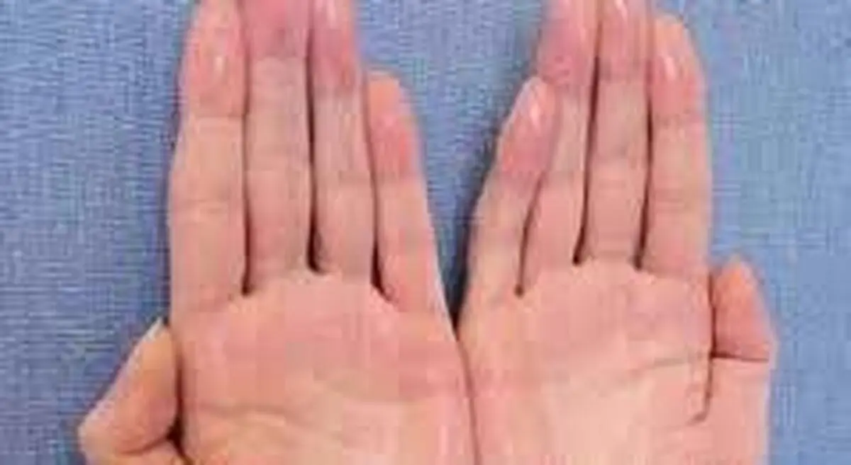 درمان قارچ پوستی