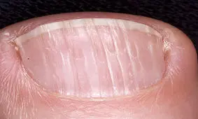 برجستگی‌های روی ناخن‌ چه می‌گویند؟