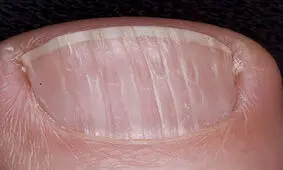 برجستگی‌های روی ناخن‌ چه می‌گویند؟