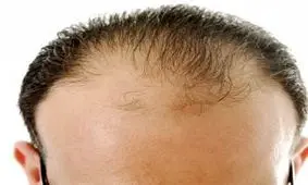 برطرف کردن ریزش مو با نسخه گیاهی