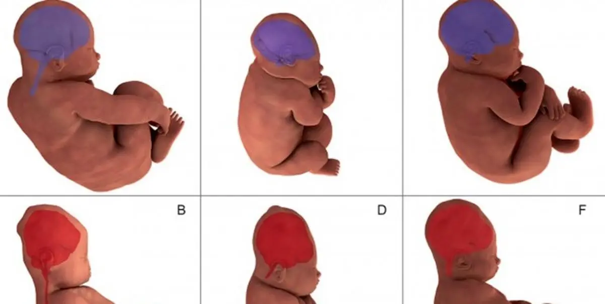 تصویربرداری سه بعدی تغییرات سر جنین را مشخص کرد