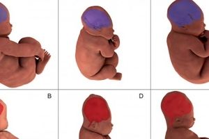 تصویربرداری سه بعدی تغییرات سر جنین را مشخص کرد