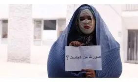 صورت‌های سوخته، امیدهای تازه/ گفت‌وگو با ۲ قربانی اسیدپاشی