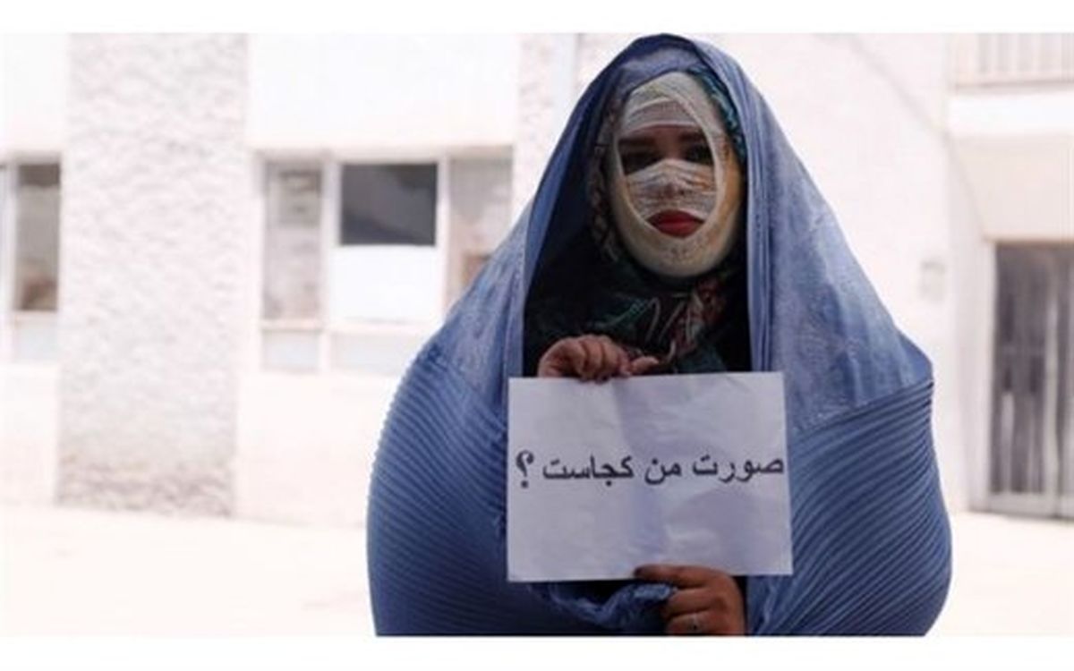 صورتهای سوخته، امیدهای تازه/ گفتوگو با ۲ قربانی اسیدپاشی