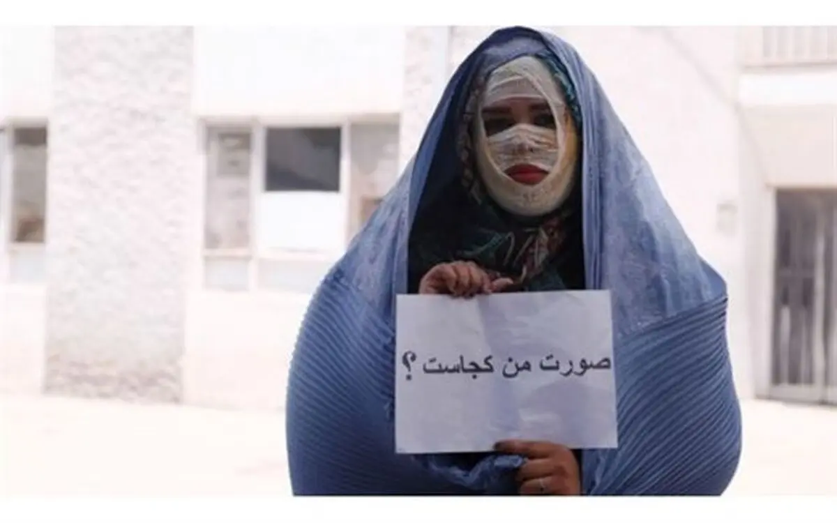 صورت‌های سوخته، امیدهای تازه/ گفت‌وگو با ۲ قربانی اسیدپاشی