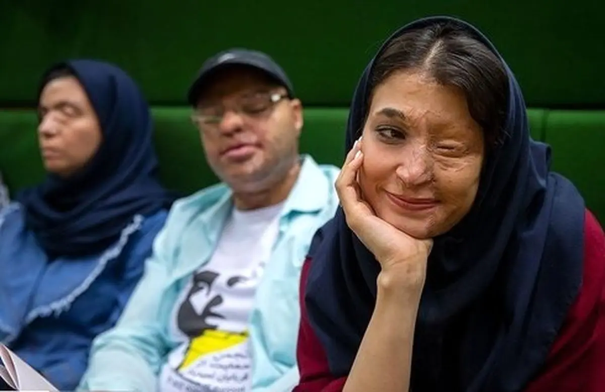 مجرمان اسیدپاشی به قصاص نفس یا عضو محکوم می‌شوند