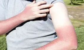 6 مشکل پوستی در فصل گرما + درمان‌های طبیعی