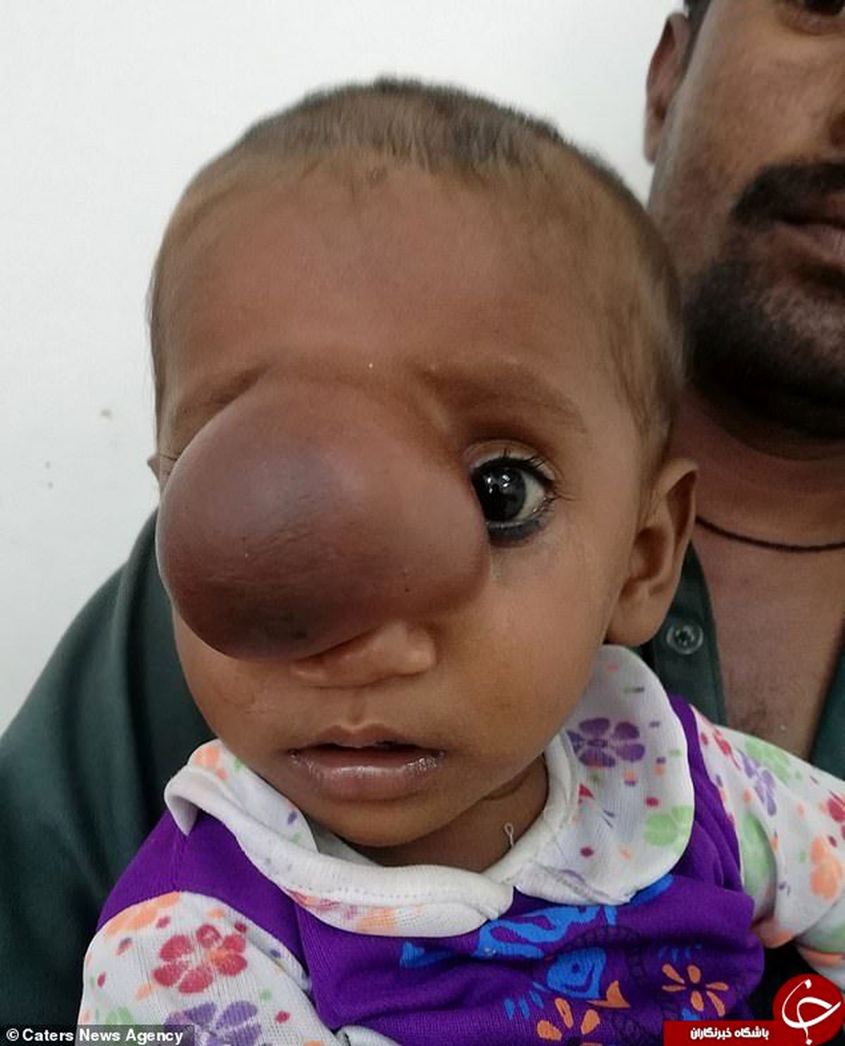 تولد کودک پاکستانی با زائده‌ای وحشتناک روی صورت