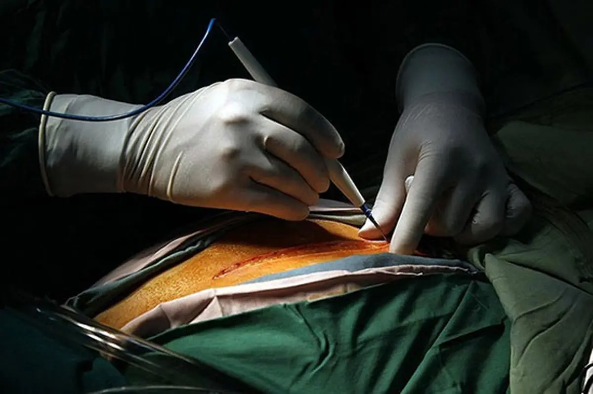 جراحی لاغری و پیکر تراشی چه عوارضی دارد؟