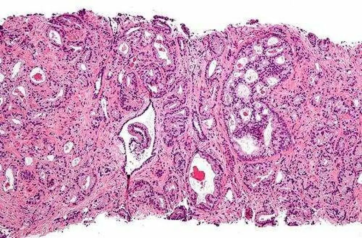 شناسایی پروتئین‌های موثر در گسترش سرطان پروستات