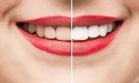روش های طبیعی برای پیشگیری از جرم دندان