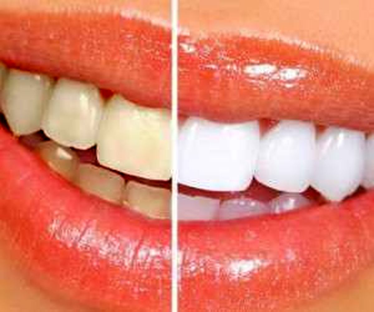 آموزش سفید کردن دندان در 3 دقیقه !