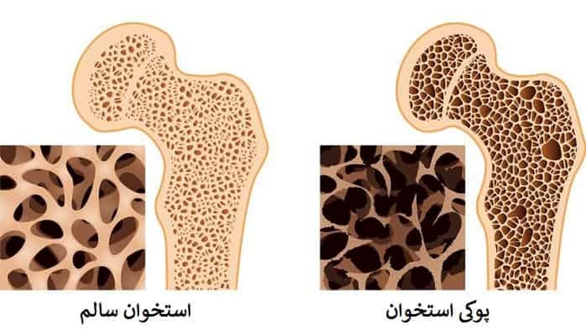 راهکارهای ساده برای جلوگیری از پوکی استخوان