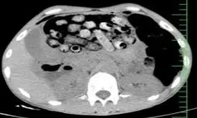 خروج ۹۰ بسته مواد مخدر از معده و روده یک بیمار در کرج