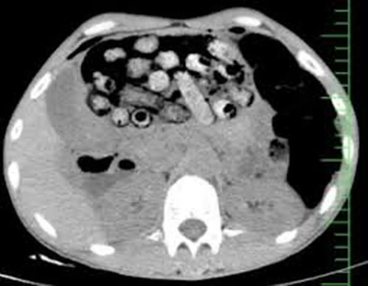 خروج ۹۰ بسته مواد مخدر از معده و روده یک بیمار در کرج