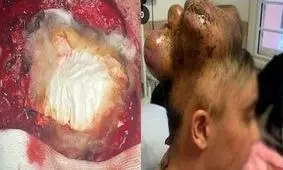 خارج کردن تومور ۳.۵ کیلویی از مغز دختر ۱۳ ساله در یزد