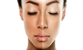 آیا لیزر تیرگی پوست را از بین می برد؟