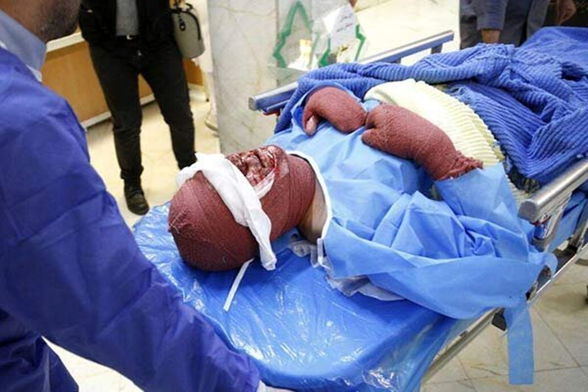 قطع دست پسر ۱۸ ساله قهدریجانی به علت انفجار ترقه