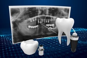 ایمپلنت دیجیتال: نوآوری در دندانپزشکی مدرن