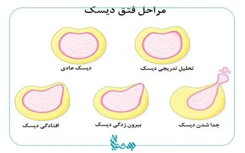 فتق دیسک گردن چیست و چه علائمی دارد؟