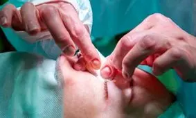 چه افرادی نباید بینی خود را عمل کنند؟