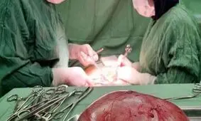 خروج غده ۳۲ کیلویی از شکم زن جوان 