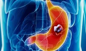 شیوع بالاتر سرطان معده در نوار شمالی کشور