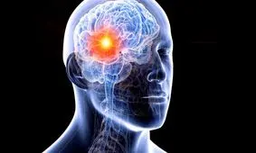 راهکار جدید برداشتن تومور مغزی/ ویدئو 15+