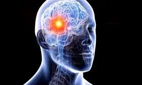 راهکار جدید برداشتن تومور مغزی/ ویدئو 15+