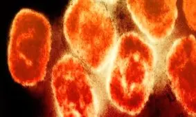 آبله میمونی می‌تواند تظاهرات عصبی-مغزی هم ایجاد کند

