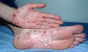 مراقب رفتارهای پرخطر جنسی باشید، آمار سفلیس درحال افزایش است