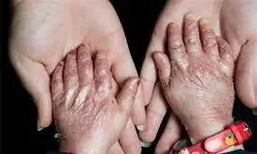 تحریم ‎های آمریکا و کارشکنی ‎های سوئد مانع دسترسی کودکان‌ «ای‌بی» به پانسمان‌