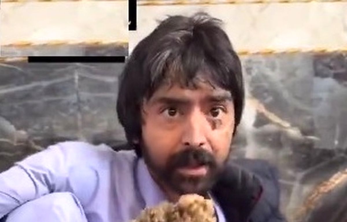 مرد درختی سیستان و بلوچستان را دریابید/ او برای درمان پیوند مغز استخوان باید به آمریکا برود/ هشدار؛ ویدئوی دلخراش