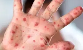 شناسایی یک کودک ۹ ماهه مبتلا به سرخک در قم