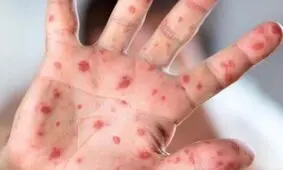 شناسایی یک کودک ۹ ماهه مبتلا به سرخک در قم