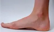 برای پیشگیری از «واریس» چه کنیم؟