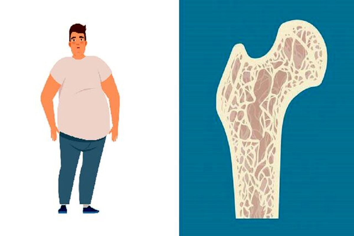 مردان چاق بیشتر در معرض خطر ابتلا به پوکی استخوان هستند