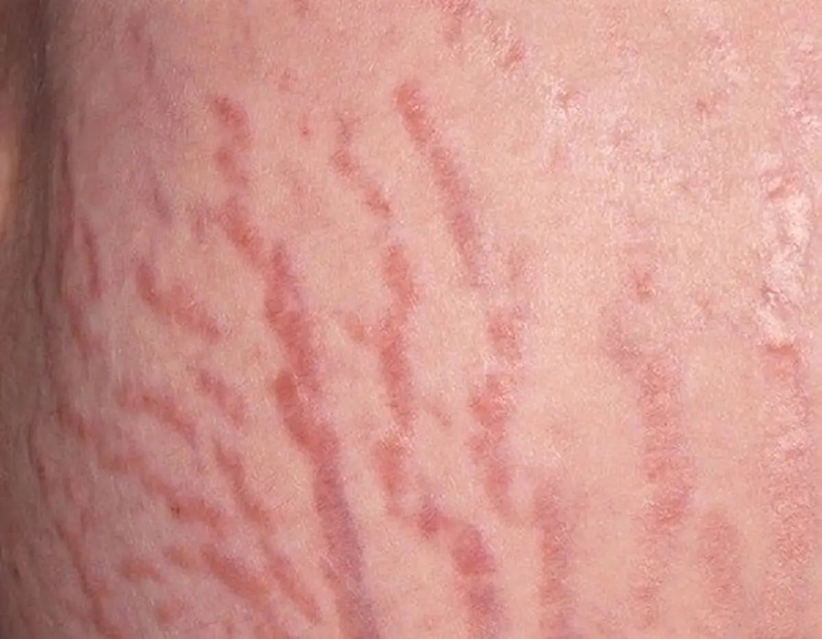 علل خارش ترک های بارداری چیست و چگونه از آن پیشگیری کنید؟