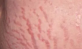 علل خارش ترک های بارداری چیست و چگونه از آن پیشگیری کنید؟
