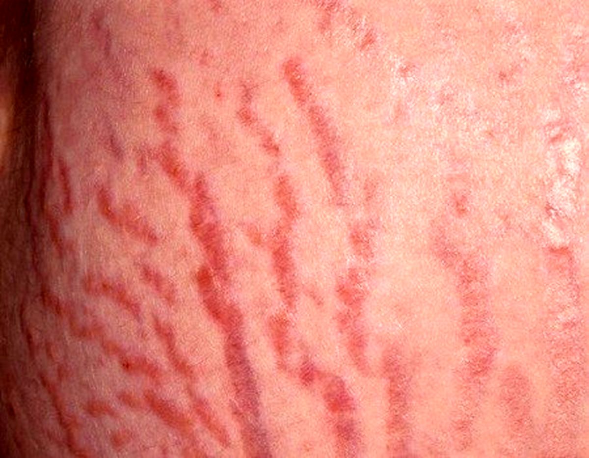علل خارش ترک های بارداری چیست و چگونه از آن پیشگیری کنید؟
