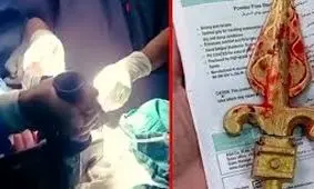 خارج کردن نیزه فلزی از دهان کودک ۱۱ ساله در ایرانشهر/ ویدئو