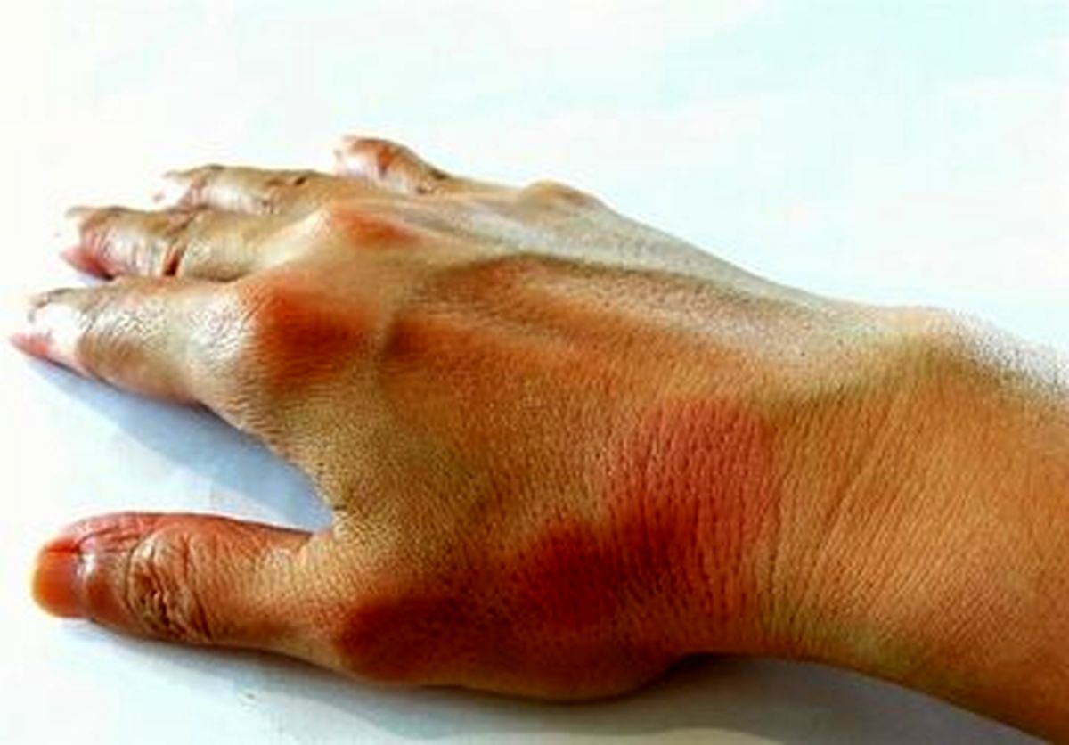 ۵ ترفند ساده تغذیهای برای بهبود زخم روی پوست