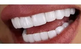 هزینه کامپوزیت دندان در تهران