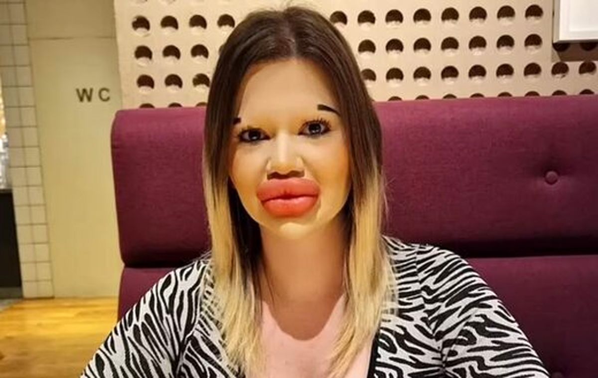 وحشت نکنید! این زن با تزریق ژل به لبهایش میخواهد رکورد گینس را بزند