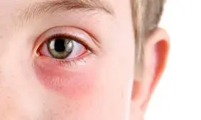 کشف درمان جدید التهاب چشم